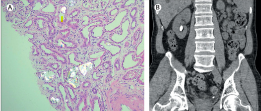 nephrology