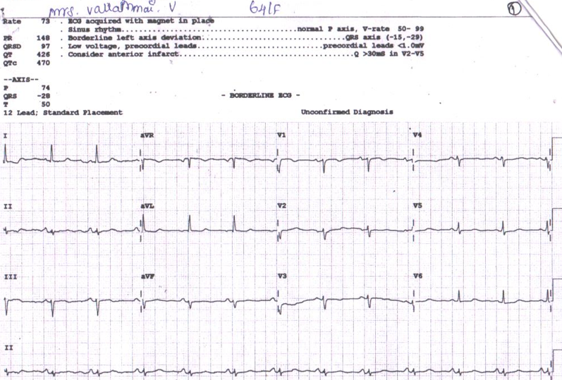 several-sinus-node-1