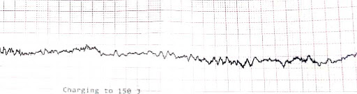 ECG-suggestive-1