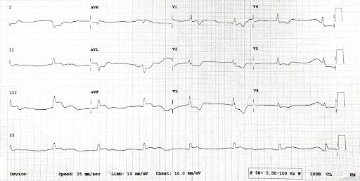 ECG-suggestive-3