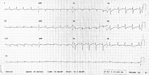 ECG-suggestive-4