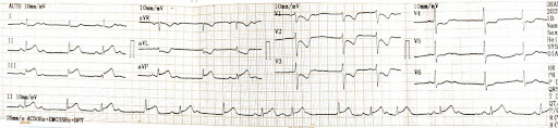 ECG-suggestive-5