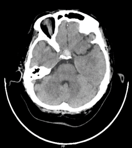 MRI-brain-4