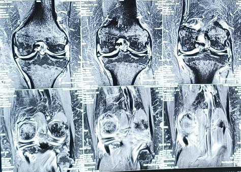 meniscus-root