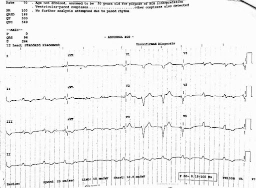 tachycardia-3