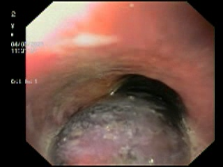 Unusual-cause-of-Dysphagia-1