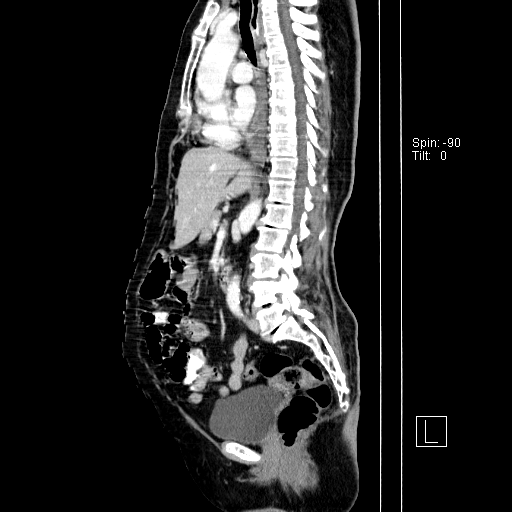 Unusual-cause-of-Dysphagia-3