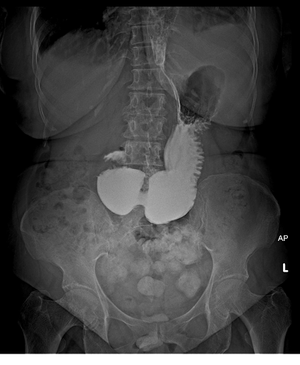 Unusual-cause-of-Dysphagia-6