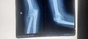 Elbow-arthroplasty-3