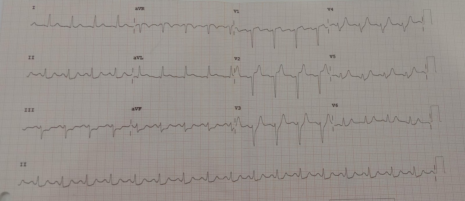 STEMI1