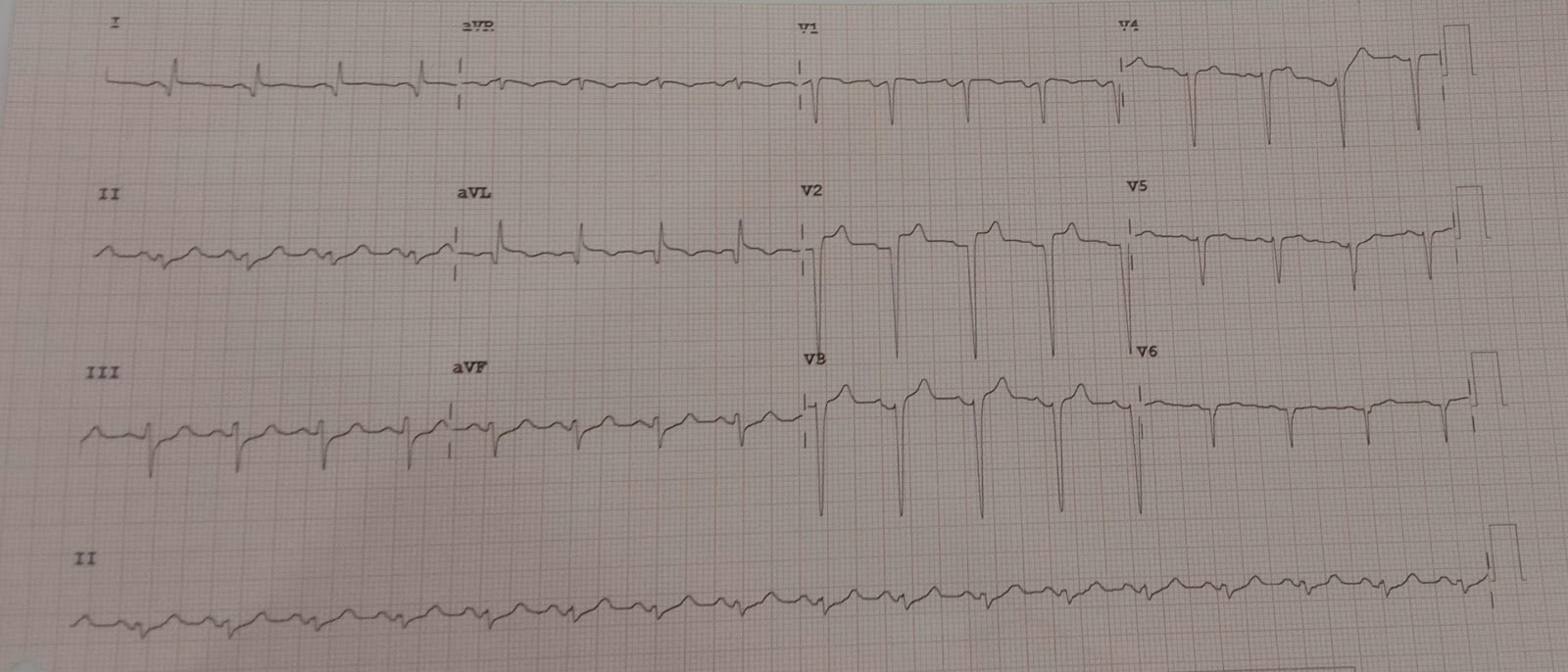 STEMI2