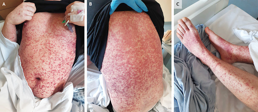 Serum-Sickness-1