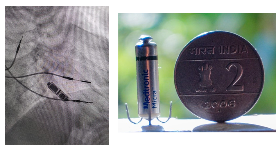 Pacemaker