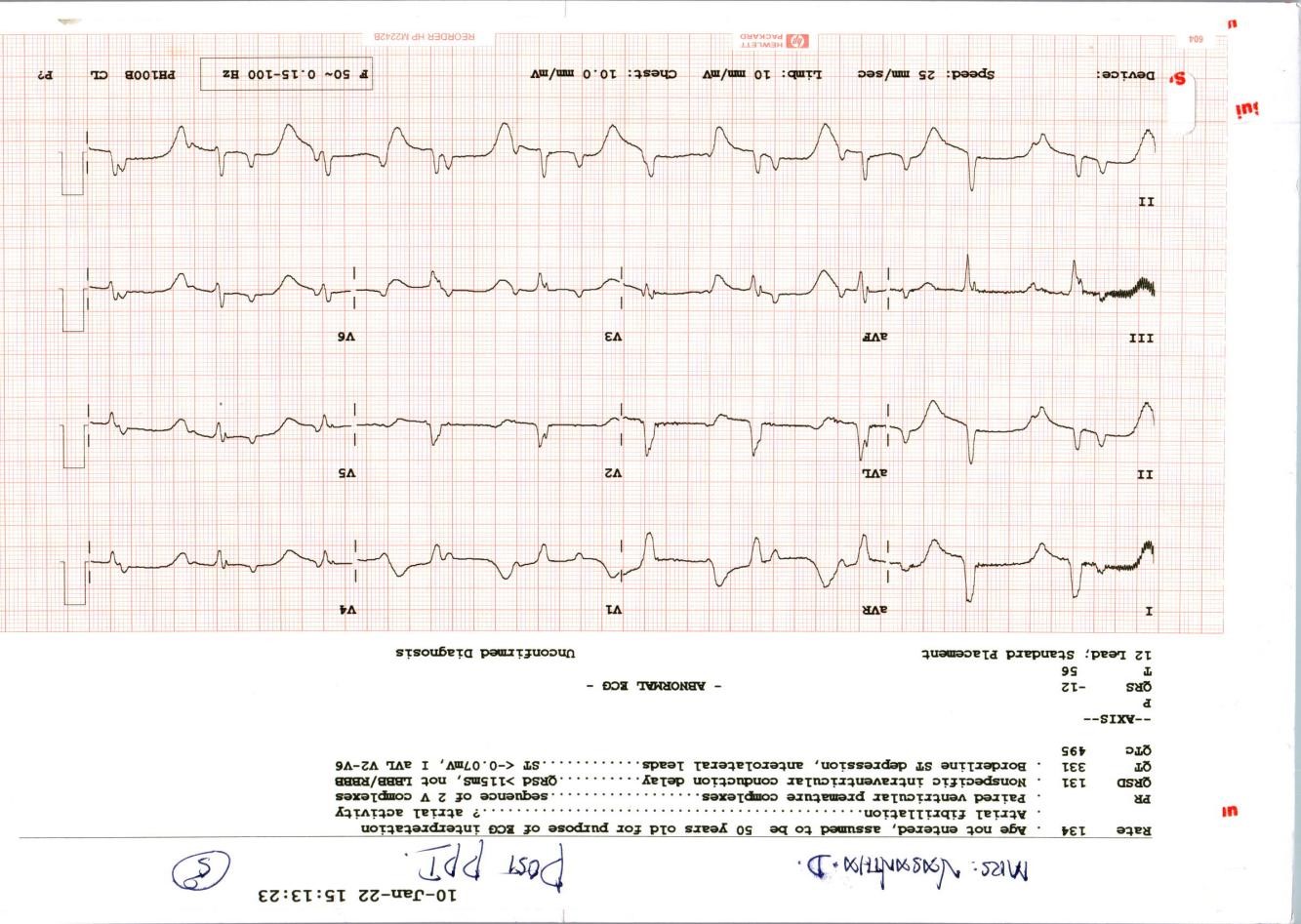 ECG-2