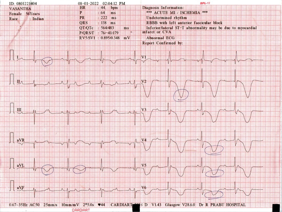 ECG