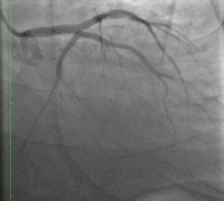 Out-of-hospital-cardiac-arrest-2