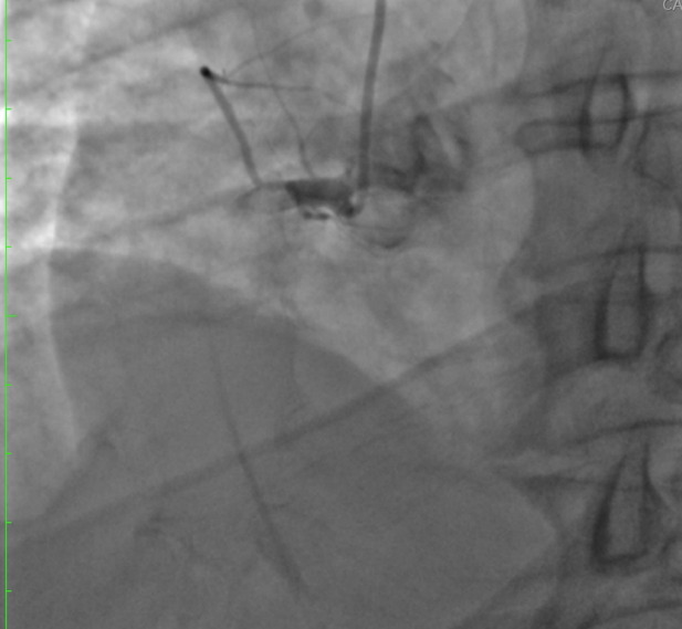 Out-of-hospital-cardiac-arrest-3
