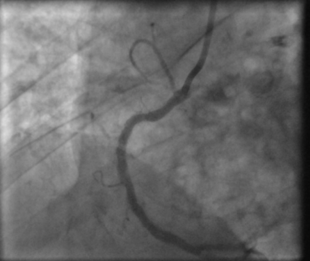 Out-of-hospital-cardiac-arrest-6