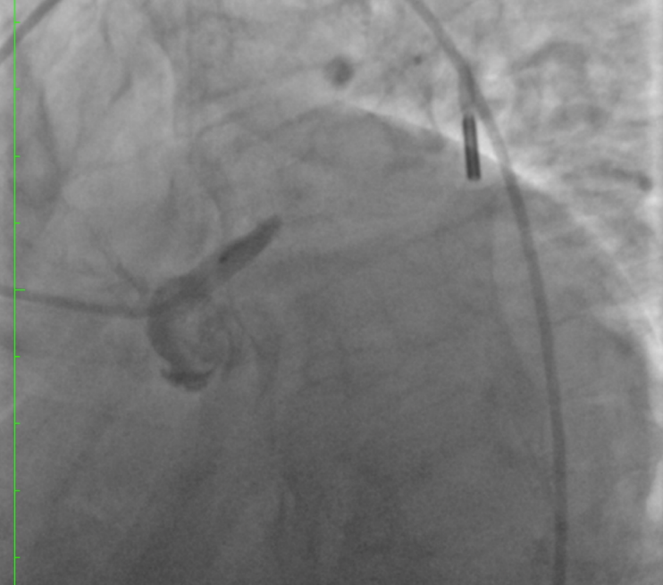 Out-of-hospital-cardiac-arrest