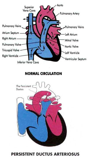 Treatment for Patent Ductus Arteriosus (PDA) in babies in Chennai, India pda