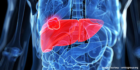 liver-cancer