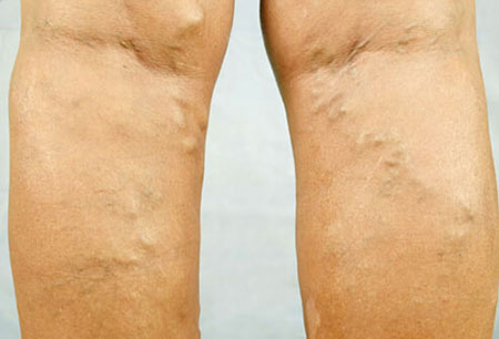 varicose_veins