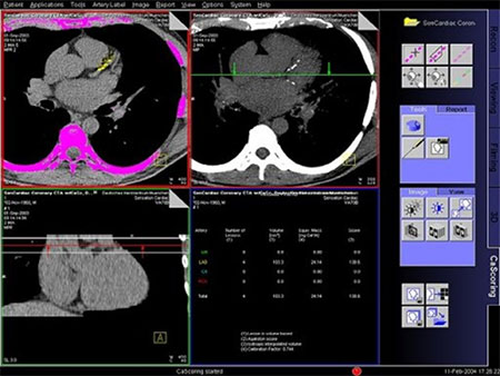 CT Calcium score ct-calcium-2