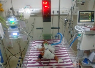 Congenital Heart Disease in Babies and Children
