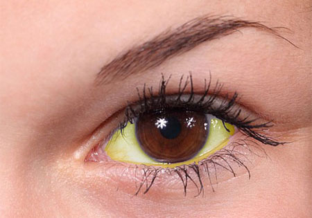 jaundice