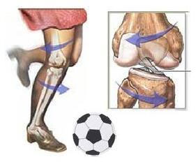 ligament-tear-2