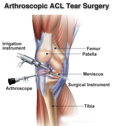 ligament-tear-3