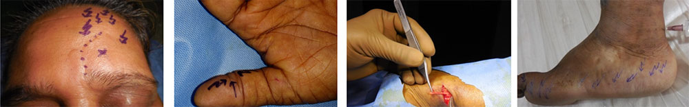 Neuroplastic Surgery in Chennai, Trichy, Salem,Tirunelveli, India plastic-surgery-1