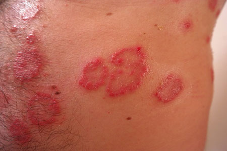 Treatment of psoriasis in Chennai, India psoriasis