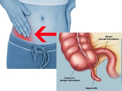 Appendicitis Treatment in Chennai, India appendicitis