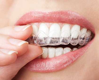 Treatment for Bruxism in Chennai, India bruxism
