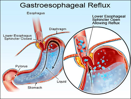 Treatment for gastroesophageal reflux disease (GERD) in Trichy, Tirunelveli| Kauvery Hospital gerd