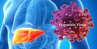 hepatitis