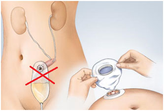 urostomy-regularly-performed-reconstruction-after-removal-of-urinary-bladder