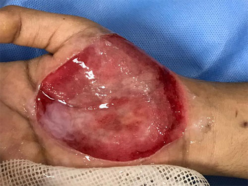 after-incision-drainage-deroofing-the-blister