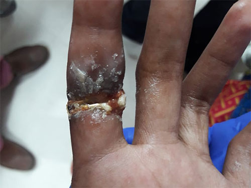 ring-causing-ulceration-infection-due-to-induration