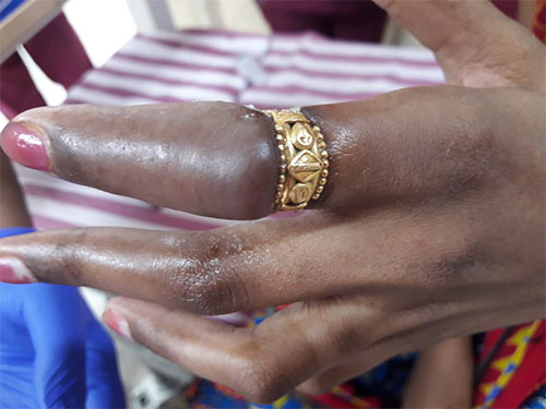 ring-constriction-causing-bluish-discolouration-over-distal-aspect-of-finger