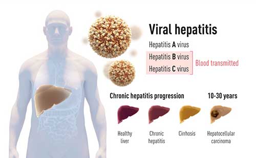 its-time-to-eradicate-hepatitis-c-infection-lets-unite