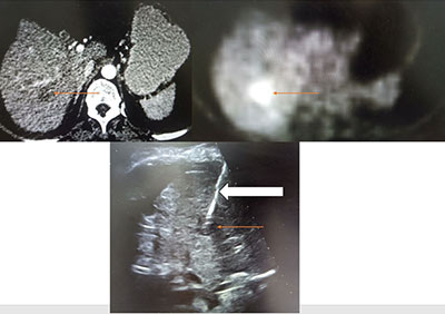image-guided-biopsies-2