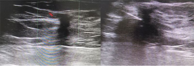 image-guided-biopsies-3