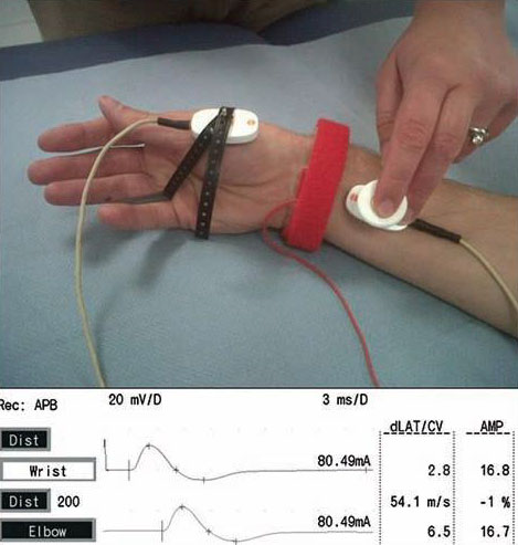 diabetes-mellitus-and-neurology-5
