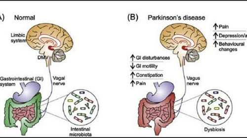 parkinsons-disease-constipation-2