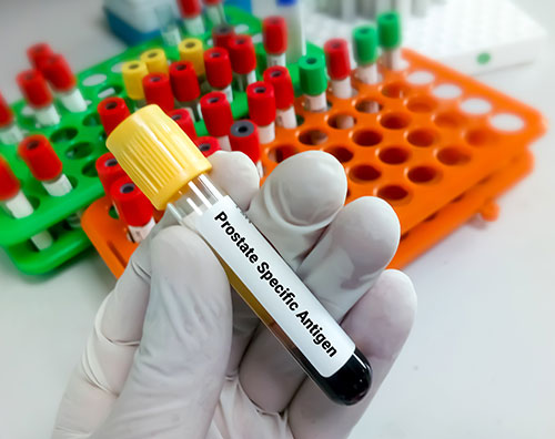 prostate-specific-antigen-the-what-why-and-how