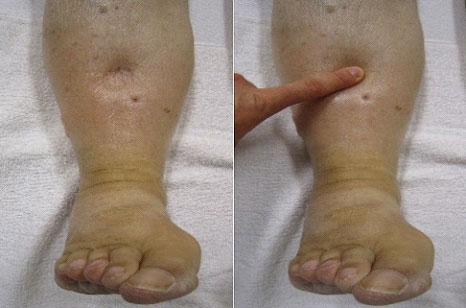 swelling-of-the-legs-edema-2