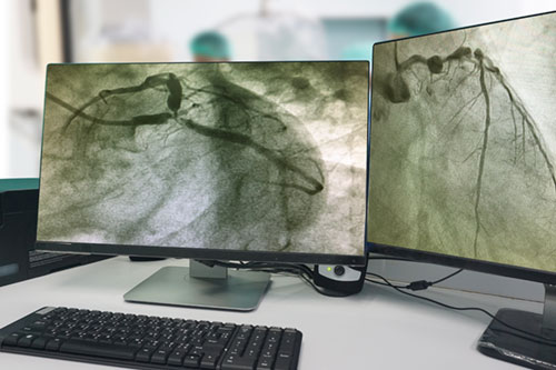 coronary-angiogram