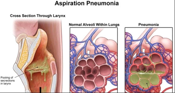 aspiration-pneumonia-in-elderly-2